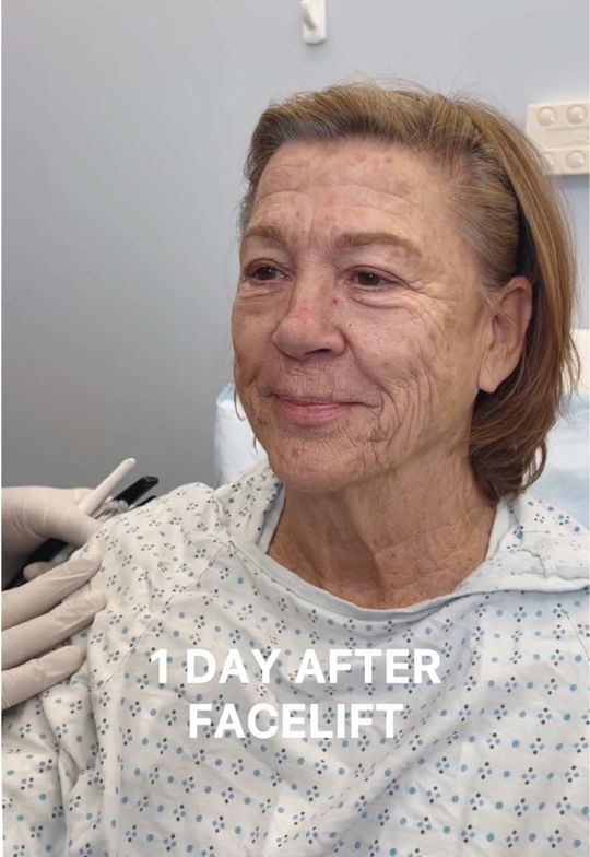 Video by Dr. Dilip D. Madnani: 1 day post-op update — our patient is just one day out from her facelift, neck lift, brow lift, u…