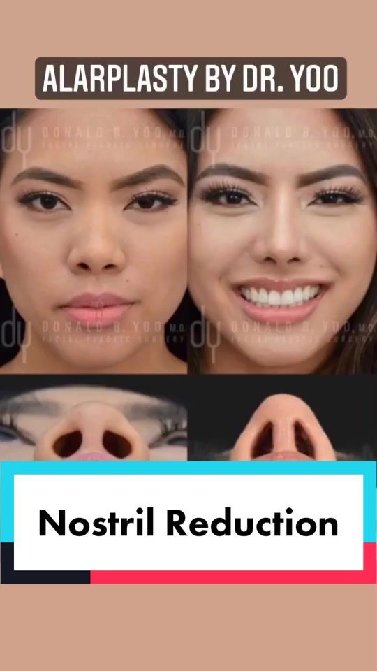 Video by Dr. Donald B. Yoo: Alar Base Reduction (Nostril reduction) ✨