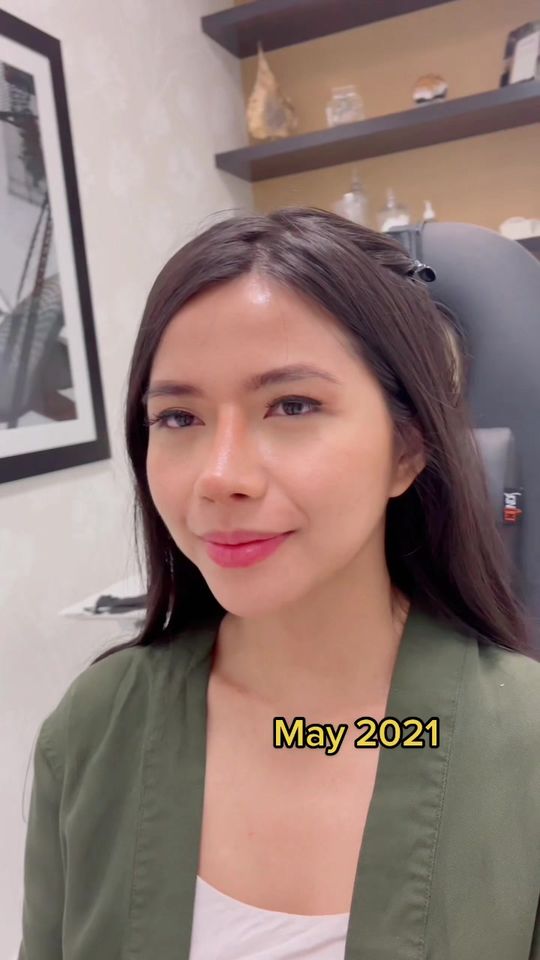 Video by Dr. Donald B. Yoo: 5 months post-op