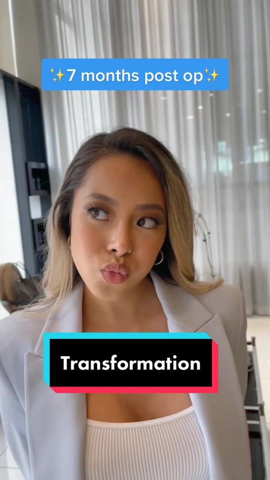 Video by Dr. Donald B. Yoo: Juliane’s primary rhinoplasty with rib cartilage and DCF