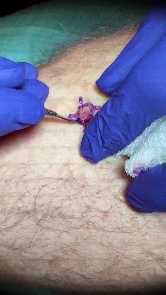 Video by Dr. Edgar Sinai Macias: Skin cancer removal 👨🏽‍⚕️💉
