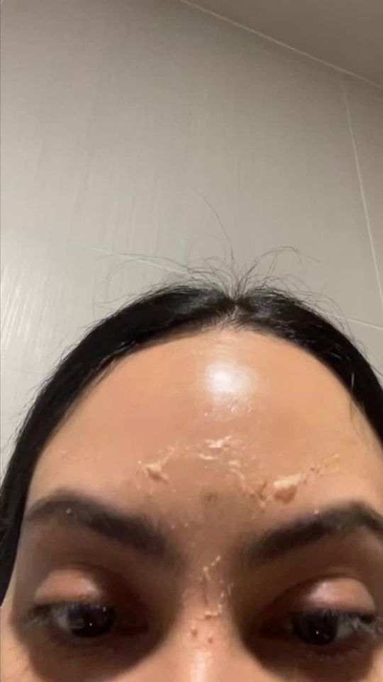 Video by Dr. Edgar Sinai Macias: Wonder what a VI Peel looks like on Day 2? 🤔Arianna shows us the process, from beginning to end!…