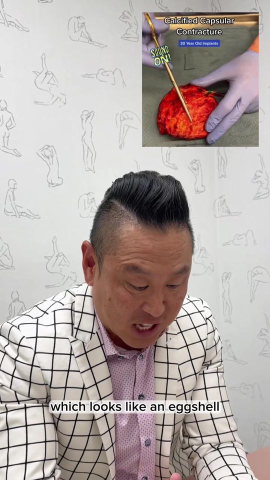 Video by Dr. Edward H. Park: Dr. Park reacts to a breast implant.