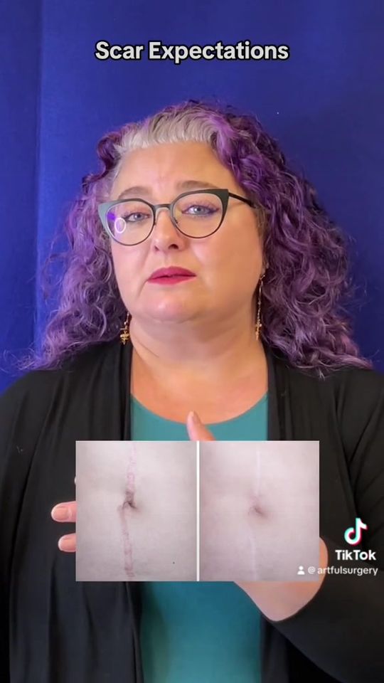 Video by Dr. Elizabeth Slass Lee: Unveiling the beauty beneath the scars ✨ As a plastic surgeon, I understand the journey of healin…