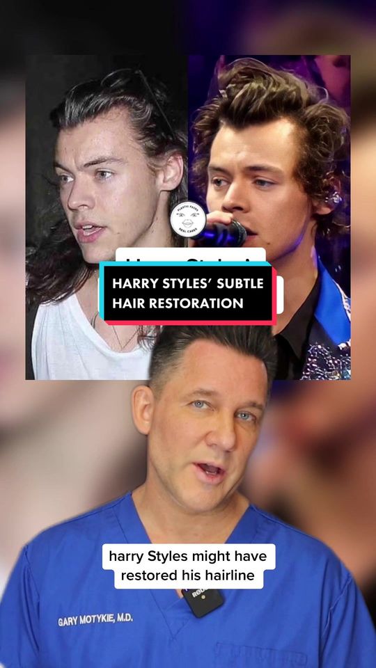 Video by Dr. Gary Motykie: Harry Styles’ subtle hair restoration 💉