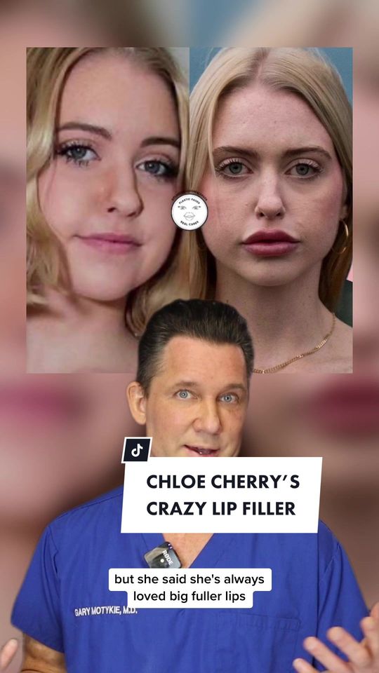 Video by Dr. Gary Motykie: Do you think Chloe Cherry’s lips are too filled?