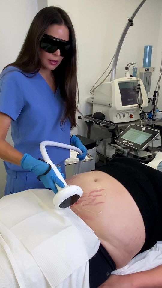 Video by Dr. Glenn Vallecillos: How to get rid of stetch marks with Intense Pulsed Light (IPL) 🤩