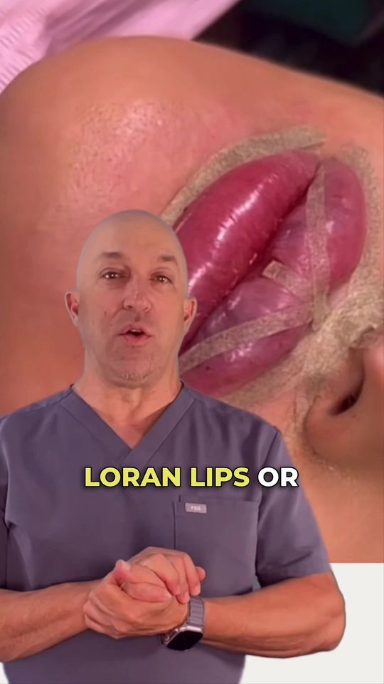 Video by Dr. Glenn Vallecillos: Loran lips / the butterfly technique 👄 Find out if one of the latest lip filler trends is worth…