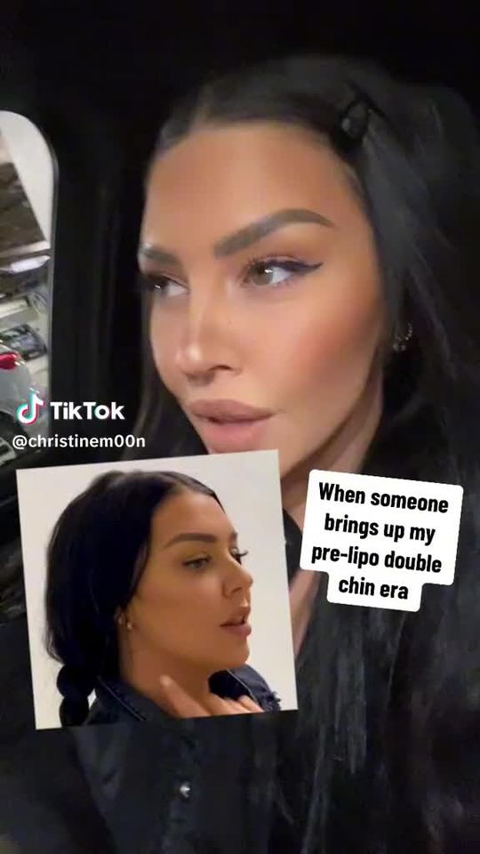 Video by Dr. Glenn Vallecillos: Snatched jaw by Dr. V 💅 | Submental Liposuction + FaceTite Call us to book your consultation tod…