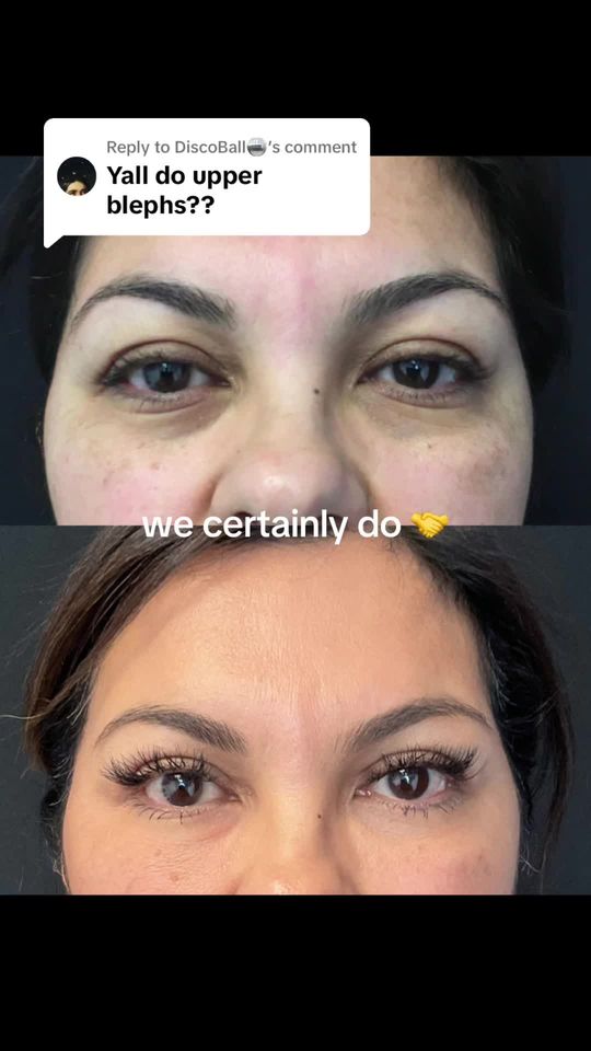 Video by Dr. Glenn Vallecillos: Replying to @DiscoBall🪩 Yes, we certainly do! 👀✨ Here are two before & afters of upper blepharo…