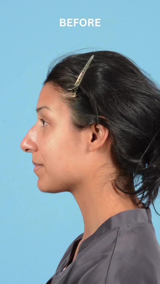 Video by Dr. Henry Mentz: 👃🏻🪡 Dr. Mentz contoured the tip, reduced projection, and lowered the dorsal hump— giving the p…