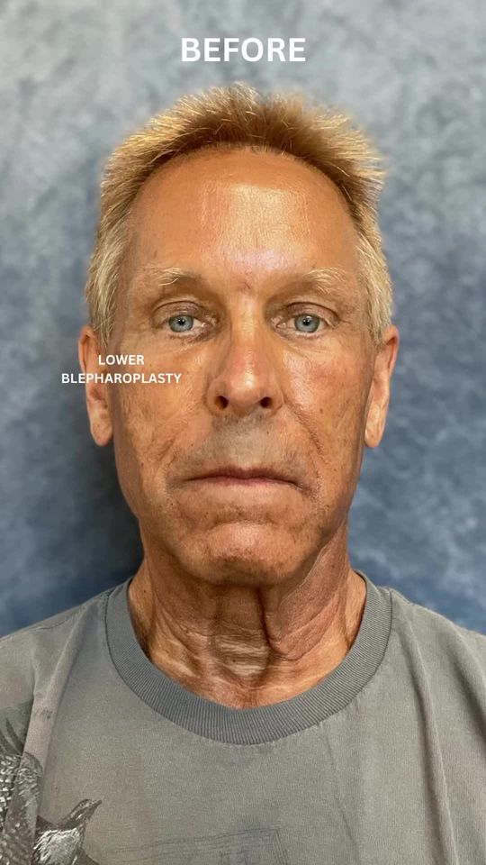 Video by Dr. Henry Mentz: 𝙊𝙪𝙩 𝙤𝙛 𝙨𝙩𝙖𝙩𝙚 𝙥𝙖𝙩𝙞𝙚𝙣𝙩? 𝗡𝗼 𝗽𝗿𝗼𝗯𝗹𝗲𝗺! This before photo is from our patient…