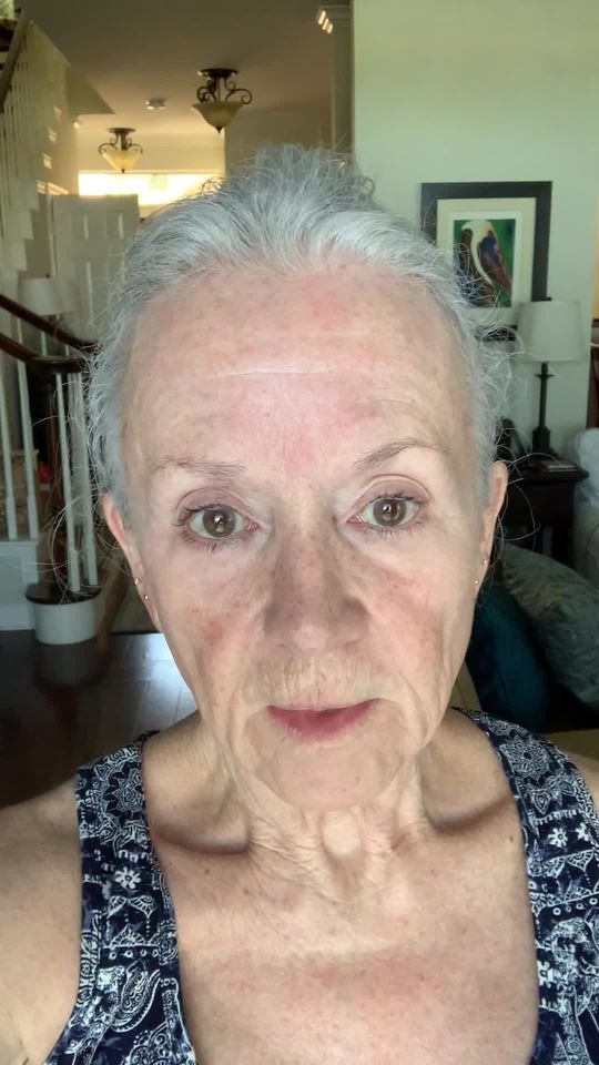 Video by Dr. Henry Mentz: 𝗙𝗮𝗰𝗶𝗮𝗹 𝗥𝗲𝗷𝘂𝘃𝗲𝗻𝗮𝘁𝗶𝗼𝗻 𝗝𝗼𝘂𝗿𝗻𝗲𝘆 𝗣𝗧 𝟭 ✨ Thank you to our beautiful patient…