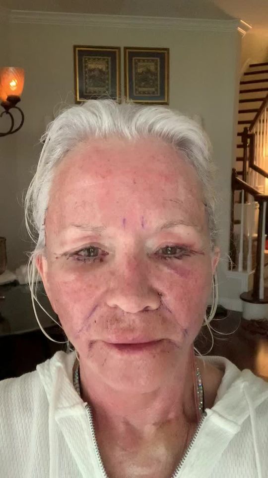 Video by Dr. Henry Mentz: 𝗙𝗮𝗰𝗶𝗮𝗹 𝗥𝗲𝗷𝘂𝘃𝗲𝗻𝗮𝘁𝗶𝗼𝗻 𝗝𝗼𝘂𝗿𝗻𝗲𝘆 𝗣𝗧 𝟮 ✨ Day 2 after her Facelift + Necklif…