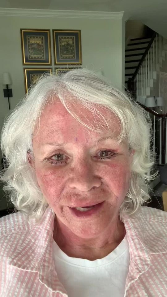 Video by Dr. Henry Mentz: 𝗙𝗮𝗰𝗶𝗮𝗹 𝗥𝗲𝗷𝘂𝘃𝗲𝗻𝗮𝘁𝗶𝗼𝗻 𝗝𝗼𝘂𝗿𝗻𝗲𝘆 𝗣𝗧 𝟯 ✨ Day 3 after her Facelift + Necklif…