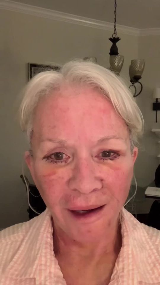 Video by Dr. Henry Mentz: 𝗙𝗮𝗰𝗶𝗮𝗹 𝗥𝗲𝗷𝘂𝘃𝗲𝗻𝗮𝘁𝗶𝗼𝗻 𝗝𝗼𝘂𝗿𝗻𝗲𝘆 𝗣𝗧 𝟰 ✨ Day 4 after her Facelift + Necklif…