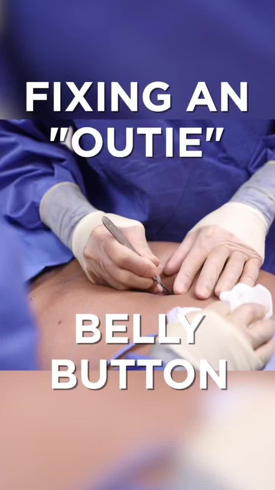 Video by Dr. J. Timothy Katzen: Did you know that all “outie” belly buttons are hernias?