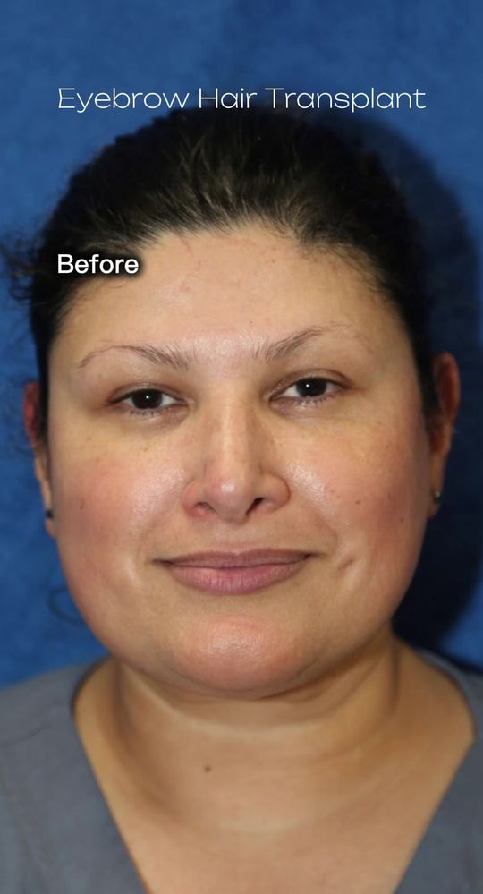 Video by Dr. J. Timothy Katzen: If you’re tired of drawing in your eyebrows, consider hair transplant! This is done in the office…