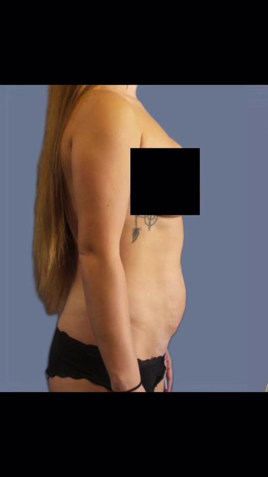 Video by Dr. Jacob Gerzenshtein: Mini tummy tuck procedure to get rid of that loose skin after baby