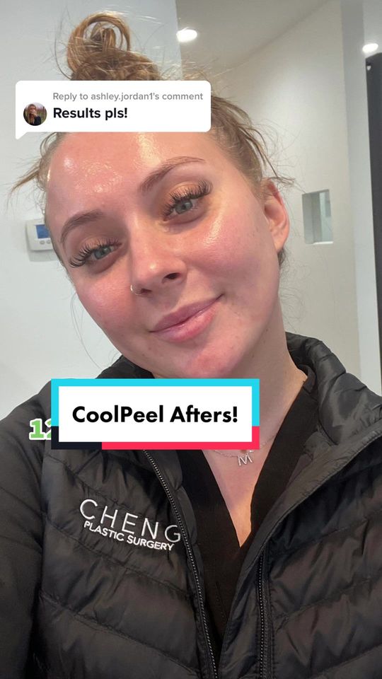 Video by Dr. Jacqueline T. Cheng: Replying to @ashley.jordan1 13 days post CoolPeel, and glowing! 🤩 Are you ready to book a compli…