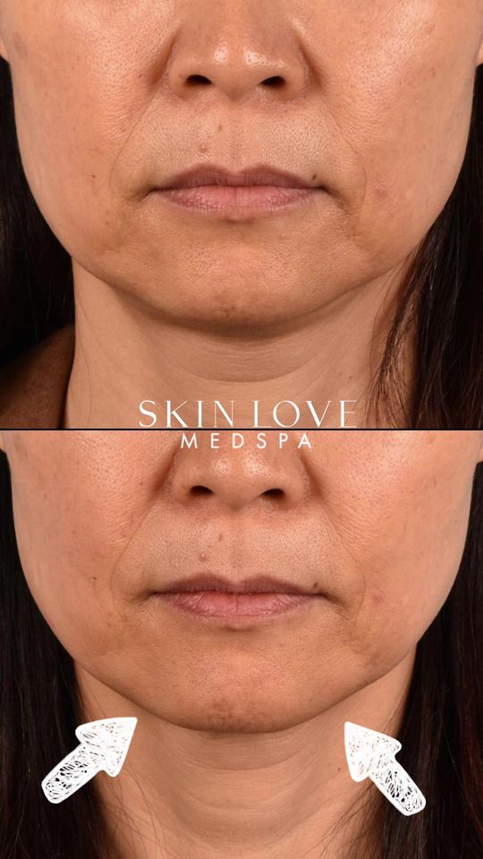 Video by Dr. Jacqueline T. Cheng: Four months after skin tightening with Ultherapy, and our patient couldn’t be looking more stunni…