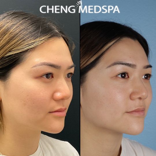 Video by Dr. Jacqueline T. Cheng: Check the out the gorgeous @Ellen Park just ONE month post-Ultherapy! 🤩 ℹ️ Ultherapy is a non-in…
