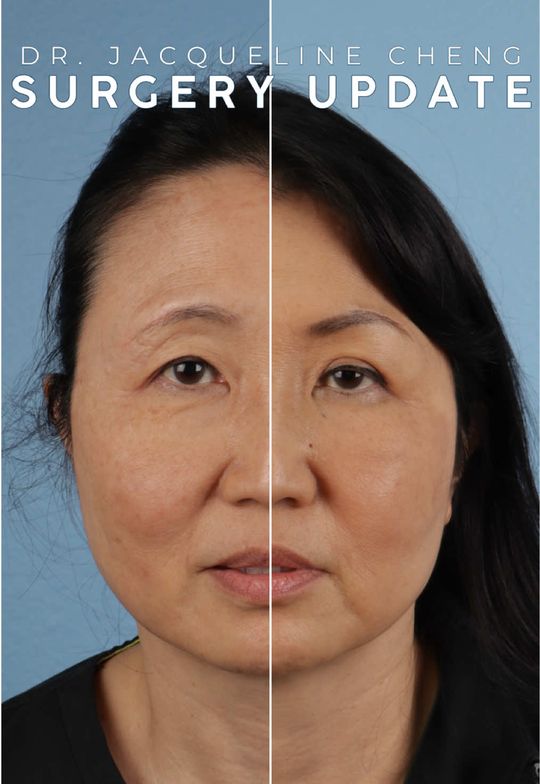 Video by Dr. Jacqueline T. Cheng: Even surgeons deserve a little self-care ✨ Check out Dr. Jacqueline Cheng’s before & after her ey…