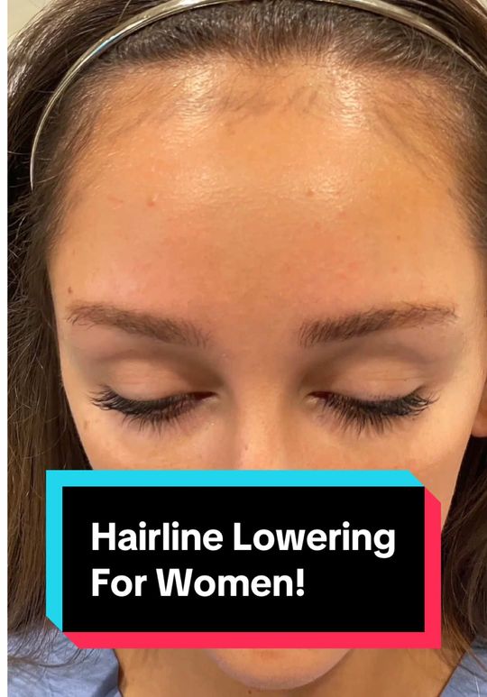 Video by Dr. Jae Pak: A lower hairline changes everything. ✨No filters. No hairline scar or forehead contouring. Just y…