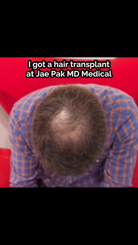 Video by Dr. Jae Pak: Thinning crown? Not anymore. Real growth, natural coverage, and zero guesswork—Dr. Pak’s precisio…
