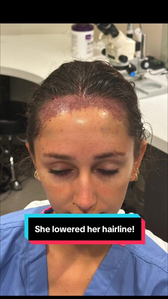 Video by Dr. Jae Pak: A softer, more balanced hairline can change how your whole face reads. Hairline Lowering with Dr.…