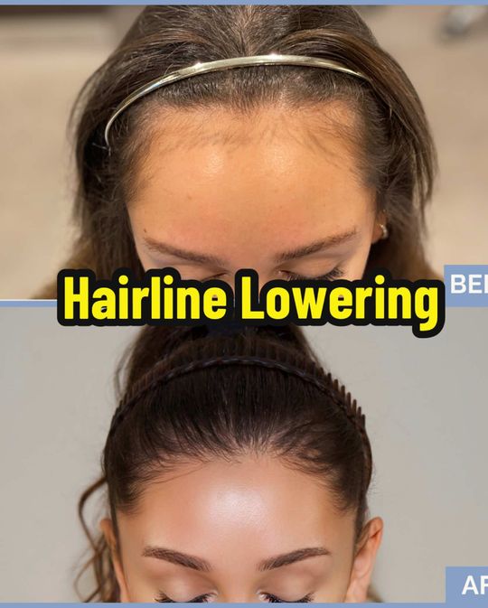 Video by Dr. Jae Pak: That moment when you stop overthinking and choose what’s been on your mind. Hairline lowering by…