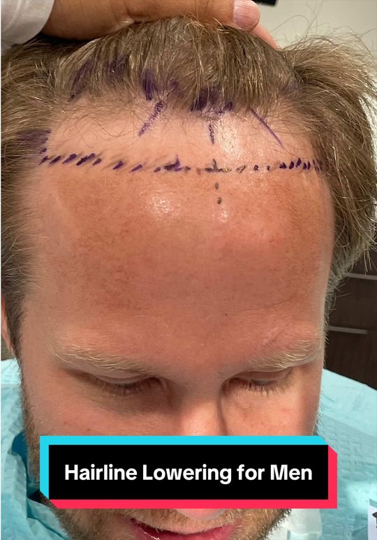 Video by Dr. Jae Pak: Hair loss happens gradually. The right solution restores it naturally. Precision hair transplanta…