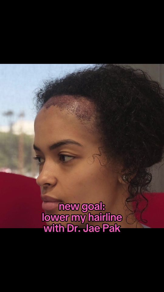 Video by Dr. Jae Pak: Hairline Lowering brings your hairline forward to better frame your face soft, intentional, and e…