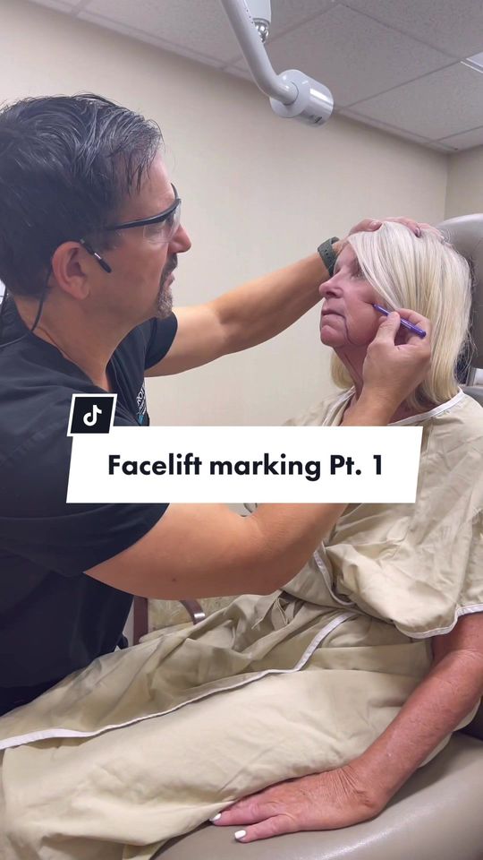 Video by Dr. James C. Marotta: Facelift marking