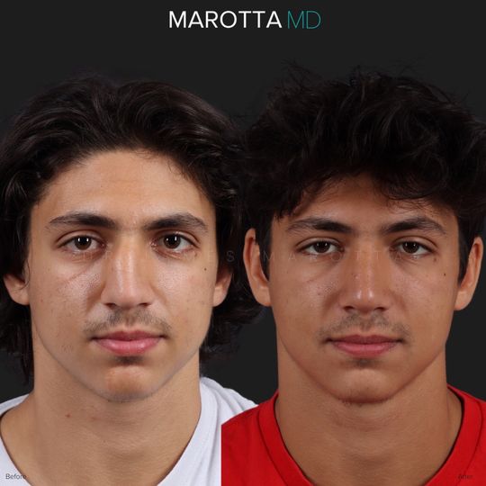 Video by Dr. James C. Marotta: One year results of Rhinoplasty. After a broken nose, this patient came in to see Dr. Marotta. Th…