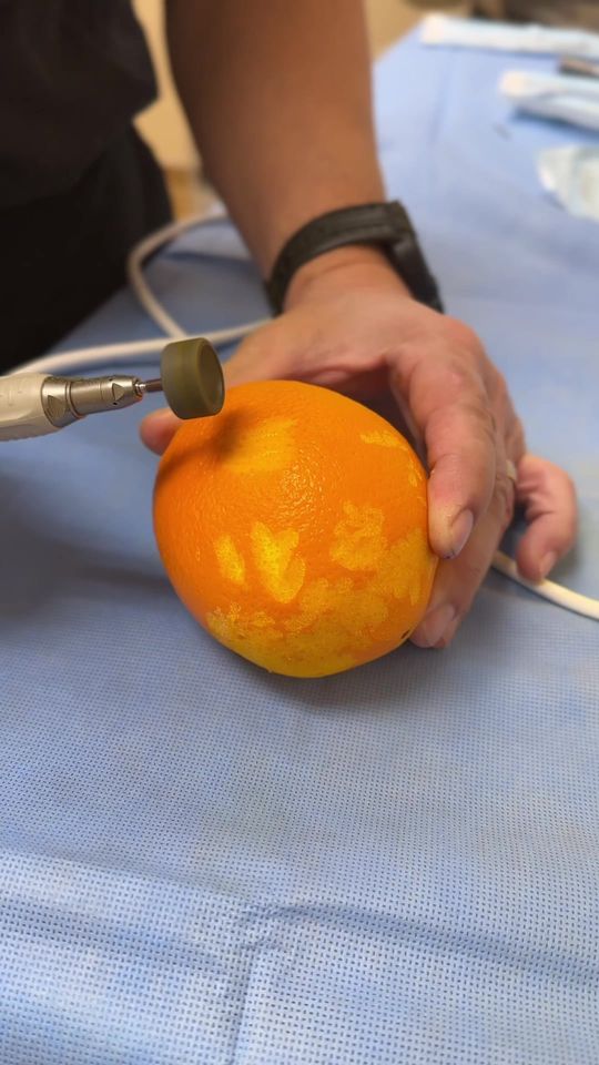 Video by Dr. James C. Marotta: Testing out our dermabarder on an 🍊