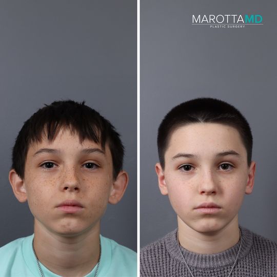 Video by Dr. James C. Marotta: Check out the remarkable transformation of our patient’s otoplasty journey 👂 👂 What is Otoplast…