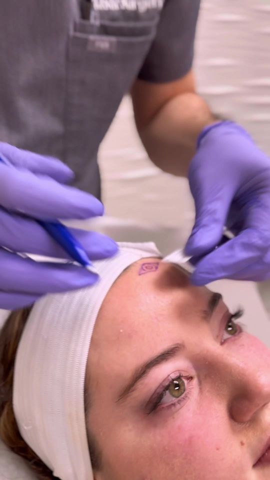Video by Dr. James N. Romanelli: Our patient was diagnosed with Basal cell carcinoma and Dr Low excised the lesion 💉✨🖋️ shes ove…