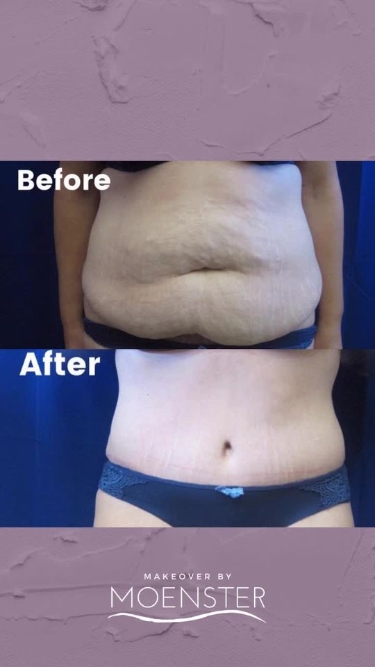 Video by Dr. Jamie Moenster: Tighten your waist with a Tummy Tuck (abdominoplasty)! I am a board-certified plastic surgeon rea…