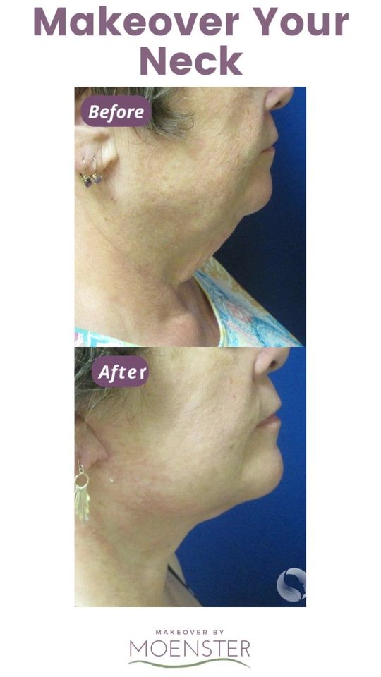 Video by Dr. Jamie Moenster: My goal is always to create and restore balance and beauty. Neck contouring, achieved through a a…