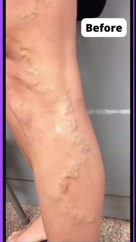 Video by Dr. Jamie Moenster: Varicose and spider veins may appear on the legs, face, or other places on the body as we age. Th…