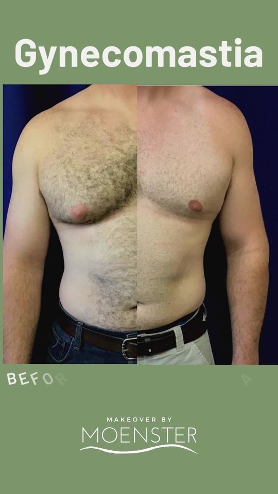 Video by Dr. Jamie Moenster: Looking for the perfect pec? Gynecomastia is a surgery that meets the needs of men who are dealin…