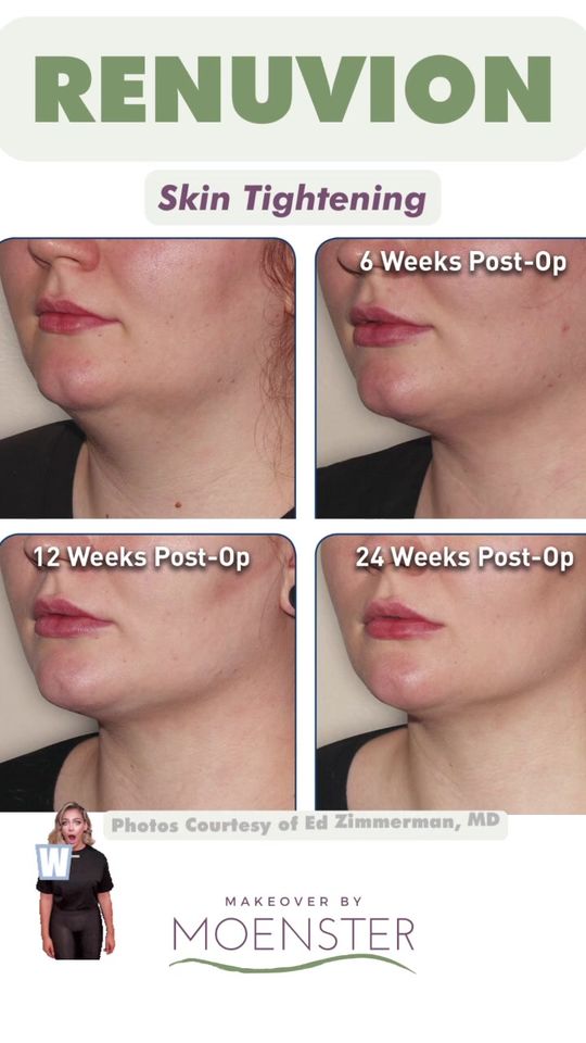 Video by Dr. Jamie Moenster: The one and only ✨Renuvion Skin Tightening✨An FDA approved procedure to tighten and rejuvenate lo…