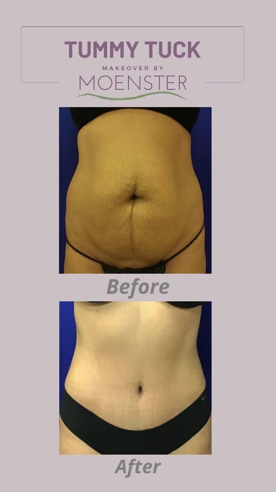 Video by Dr. Jamie Moenster: What do you think about these incredible results from a recent surgery? A tummy tuck, aka abdomin…