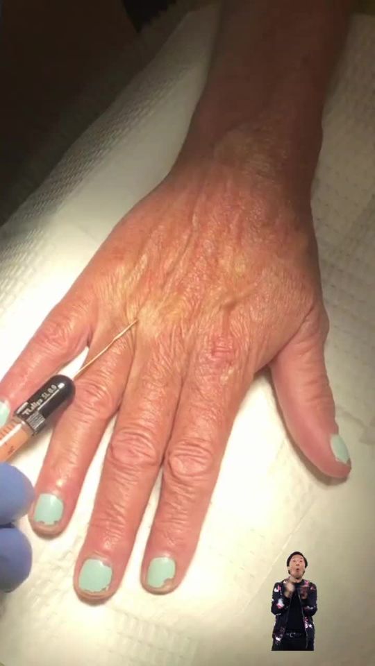 Video by Dr. Jamie Moenster: Fat transfer, uses fat from unwanted locations to plump areas such as face, lips, chest, hips, ha…