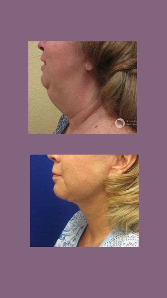 Video by Dr. Jamie Moenster: Are you self-conscious about the appearance of your neck? Consider a neck lift to help you achiev…
