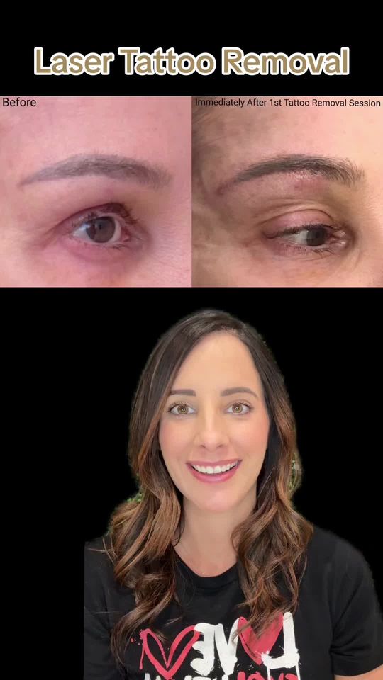 Video by Dr. Janet Allenby: Get clear, ink-free skin with Laser Tattoo Removal! ✅Erase unwanted tattoos with minimal discomfo…
