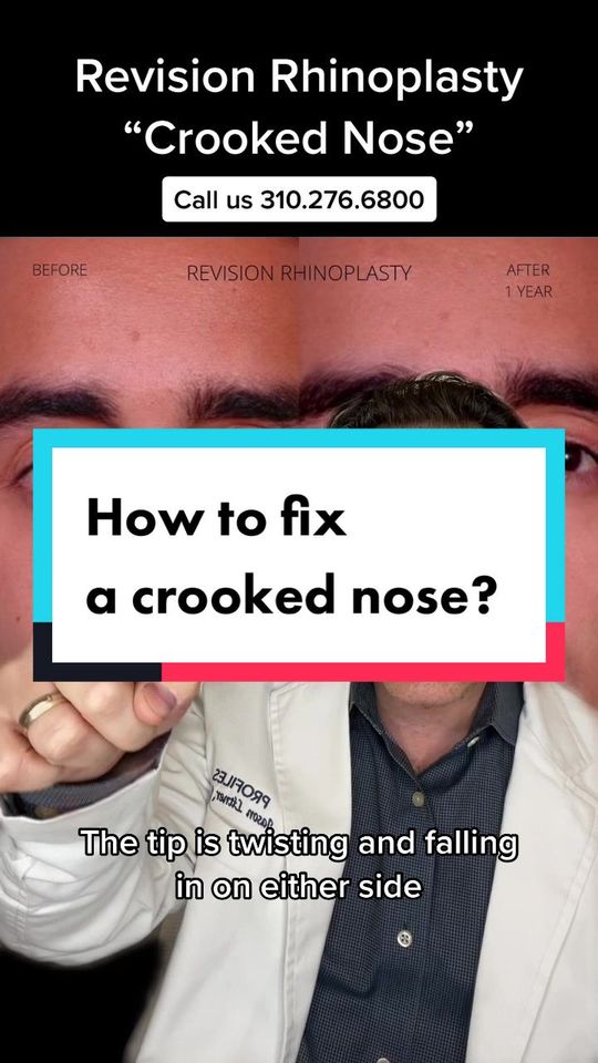 Video by Dr. Jason Litner: you know who to call if you have a crooked nose 👃