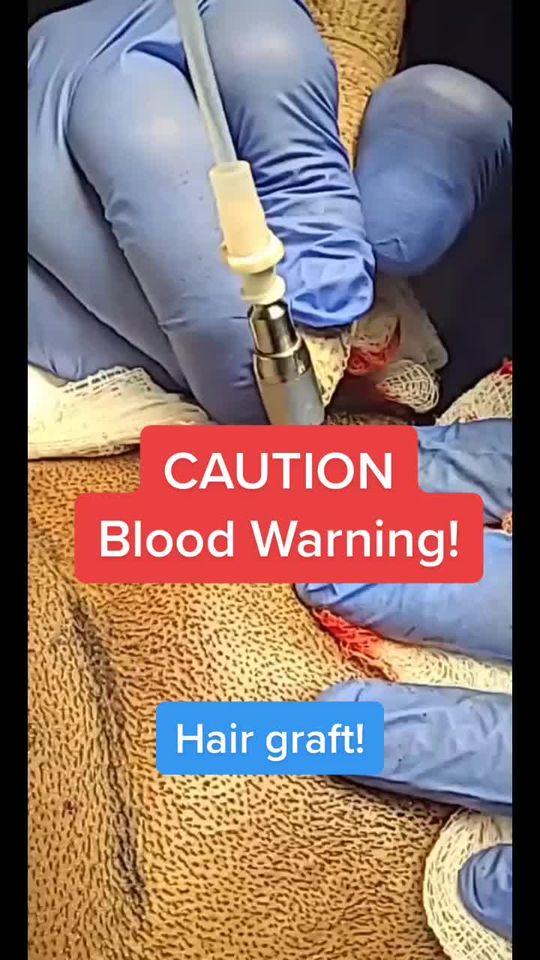 Video by Dr. Jeff Angobaldo: Process of a hair transplant! Leave a comment if you have any questions