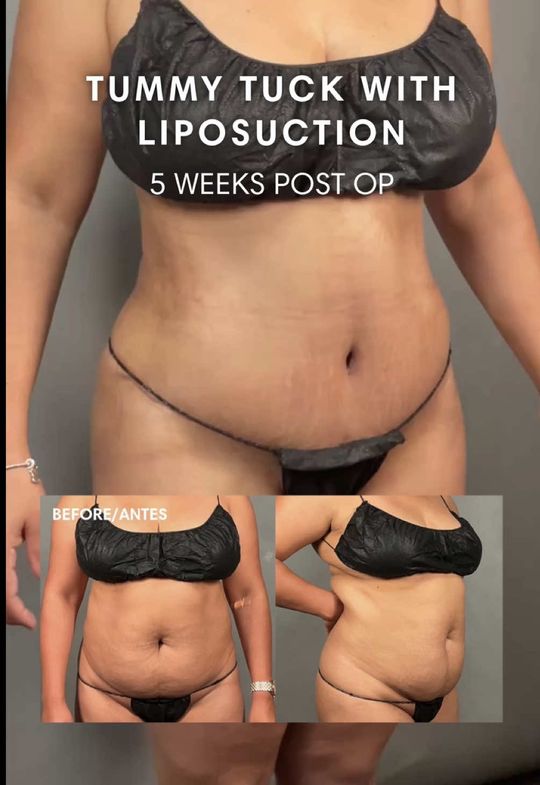 Video by Dr. Jeffrey S. Yager: 5 weeks post op from a tummy tuck and liposuction ✨ Her scar is incredibly thin, healing beautifu…
